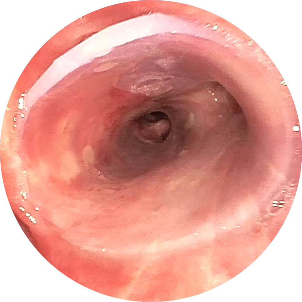 Nach Implantation 1 (Bilder freundlicherweise zur Verfügung gestellt von PD Dr. Daniel Franzen, Zürich.) Nach Implantation 1