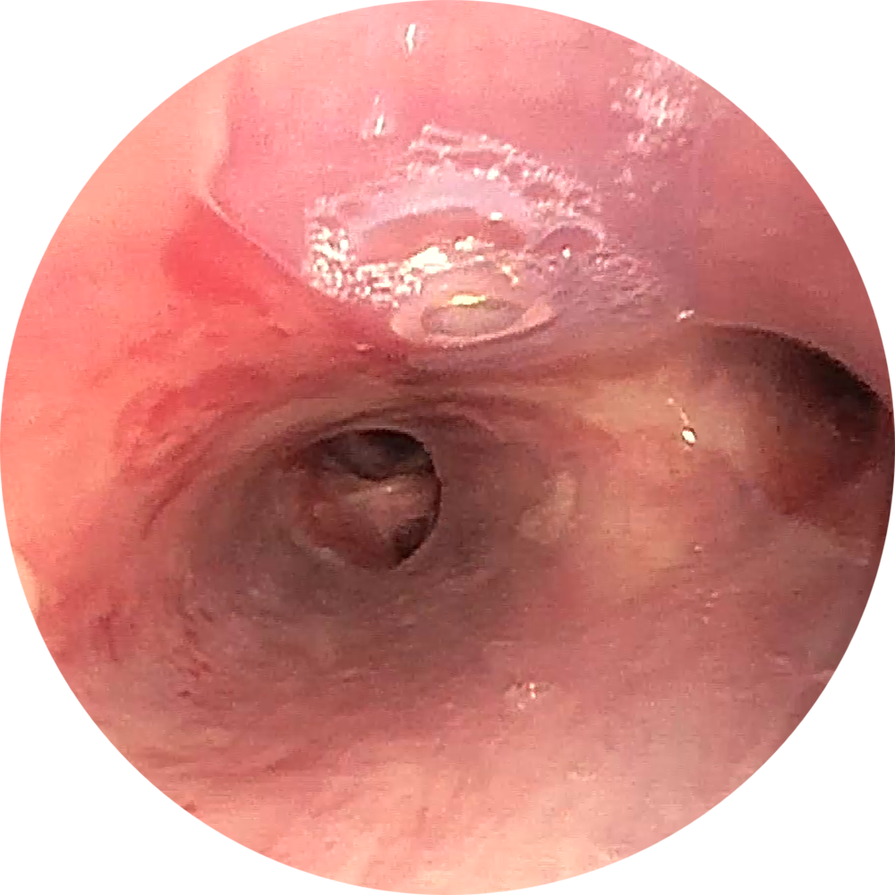 Nach Implantation 2 (Bilder freundlicherweise zur Verfügung gestellt von PD Dr. Daniel Franzen, Zürich.) Nach Implantation 2