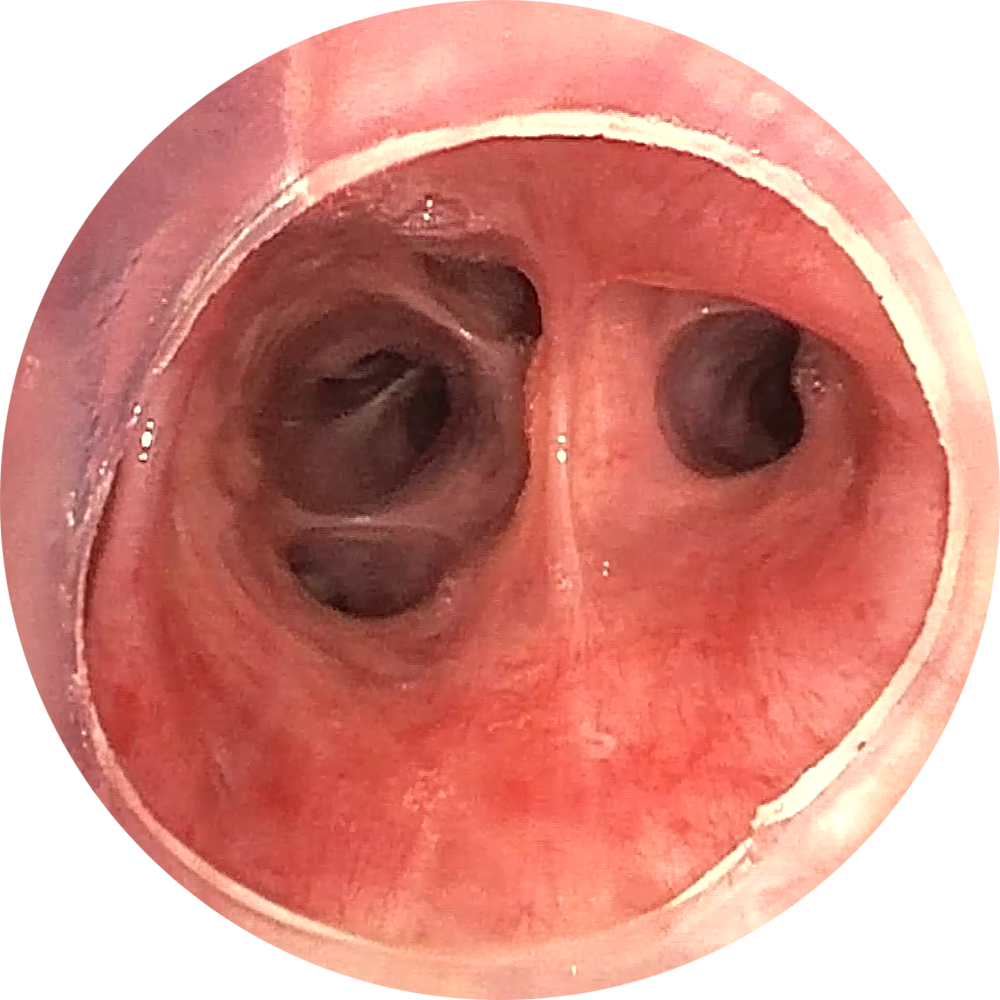 Nach Implantation 3 (Bilder freundlicherweise zur Verfügung gestellt von PD Dr. Daniel Franzen, Zürich.) Nach Implantation 3
