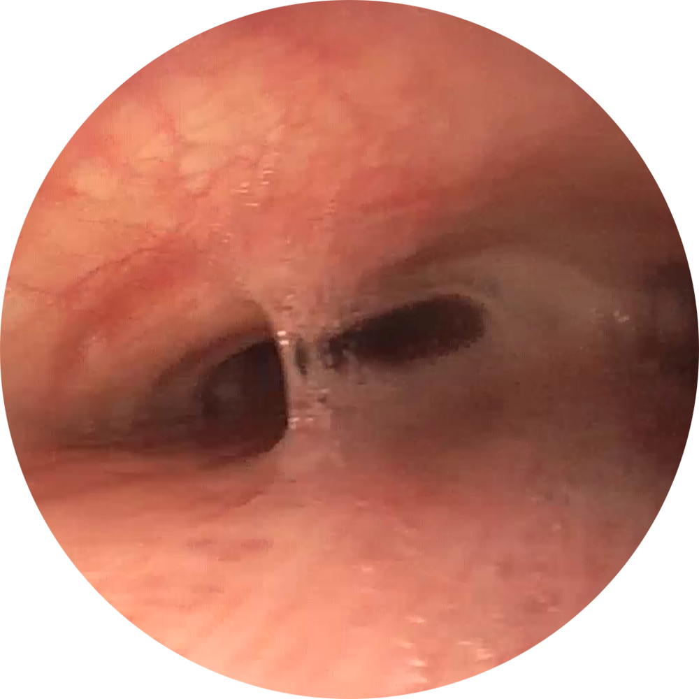 Vor Implantation (Bilder freundlicherweise zur Verfügung gestellt von PD Dr. Daniel Franzen, Zürich.) Vor Implantation