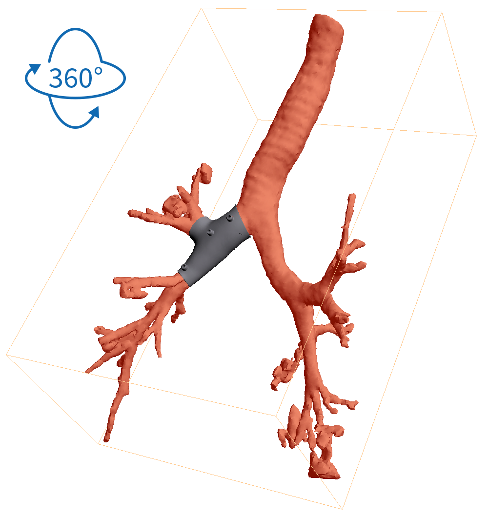 Screenshot der 3D-Visualisierung. Das Bild kann vollständig gedreht werden, um den Stent von allen Perspektiven und Winkeln betrachten zu können. Abstände und Wandstärken können gemessen werden. Screenshot der 3D-Visualisierung. Das Bild kann vollständig gedreht werden, um den Stent von allen Perspektiven und Winkeln betrachten zu können. Abstände und Wandstärken können gemessen werden.